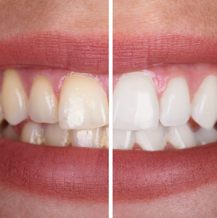 banqueamiento dental