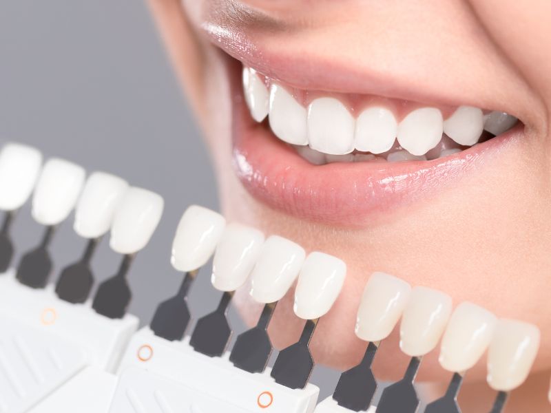 blanqueamiento dental